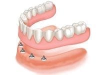 Tooth implants & dentures
