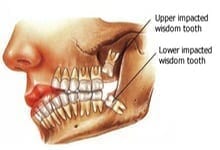 wisdom teeth extraction high prairie