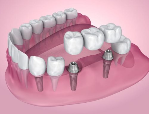 Why You Should Consider Dental Implants for Your Missing Teeth