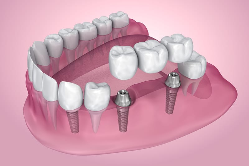 Interior of Mouth with Dental Bridge Implants