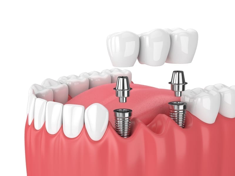 Implants with Dental bridge