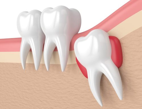 Why Is It Important To Remove Wisdom Teeth?
