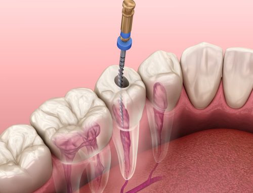 What Are Signs You May Need A Root Canal?