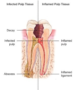 abscessed-tooth Abscessed-tooth